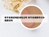 有牛皮癣进场能体检过吗 有牛皮病癣可以办健康证吗