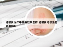 迪银片治疗牛皮癣效果怎样 迪银片可以治愈银屑病吗
