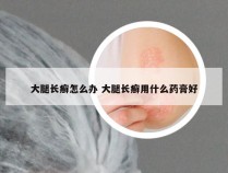 大腿长癣怎么办 大腿长癣用什么药膏好