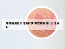 牛皮癣用什么泡澡好使 牛皮肤癣用什么泡澡好