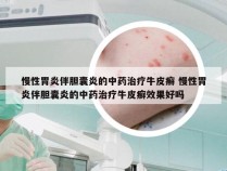 慢性胃炎伴胆囊炎的中药治疗牛皮癣 慢性胃炎伴胆囊炎的中药治疗牛皮癣效果好吗