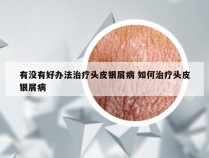 有没有好办法治疗头皮银屑病 如何治疗头皮银屑病