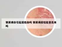 银屑病会引起尿隐血吗 银屑病尿检能查出来吗