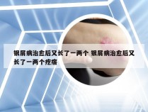 银屑病治愈后又长了一两个 银屑病治愈后又长了一两个疙瘩