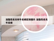 溢脂性皮炎和牛皮癣区别图片 溢脂性皮炎 牛皮癣