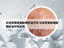 红皮型银屑病前期好治疗吗 红皮型银屑病前期好治疗吗女性