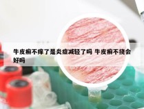 牛皮癣不痒了是炎症减轻了吗 牛皮癣不挠会好吗