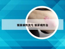 银屑病外洗亏 银屑病外治