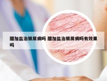 醋加盐治银屑病吗 醋加盐治银屑病吗有效果吗