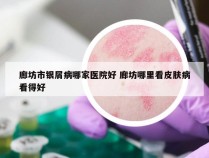廊坊市银屑病哪家医院好 廊坊哪里看皮肤病看得好
