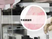 牛皮癣面积