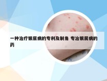 一种治疗银屑病的专利及制角 专冶银屑病的药