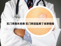 肛门周围长皮癣 肛门附近起癣了皮肤粗糙