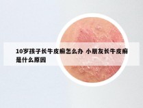 10岁孩子长牛皮癣怎么办 小朋友长牛皮癣是什么原因