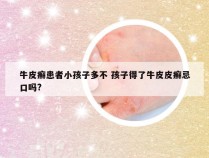 牛皮癣患者小孩子多不 孩子得了牛皮皮癣忌口吗?