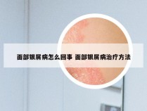 面部银屑病怎么回事 面部银屑病治疗方法