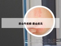 唐山牛皮癣 唐山皮炎