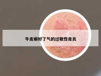 牛皮癣好了气的过敏性皮炎