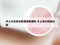 手上针尖状白屑是银屑病吗 手上有针刺感白斑