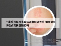 牛皮癣可以呵贞氏扶正颗粒调养吗 银屑病可以吃贞芪扶正颗粒吗