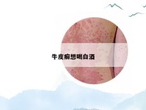 牛皮癣想喝白酒