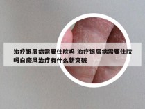 治疗银屑病需要住院吗 治疗银屑病需要住院吗白癜风治疗有什么新突破