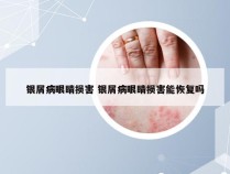银屑病眼睛损害 银屑病眼睛损害能恢复吗