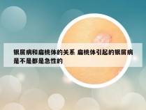 银屑病和扁桃体的关系 扁桃体引起的银屑病是不是都是急性的