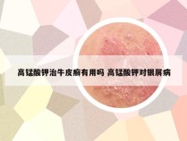 高锰酸钾治牛皮癣有用吗 高锰酸钾对银屑病