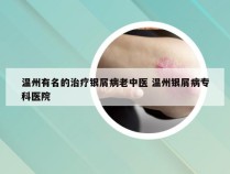 温州有名的治疗银屑病老中医 温州银屑病专科医院