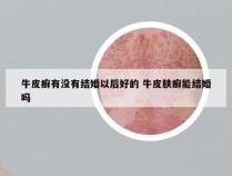 牛皮癣有没有结婚以后好的 牛皮肤癣能结婚吗