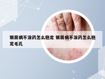 银屑病不涂药怎么稳定 银屑病不涂药怎么稳定毛孔