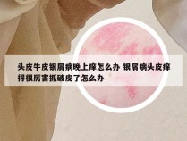 头皮牛皮银屑病晚上痒怎么办 银屑病头皮痒得很厉害抓破皮了怎么办