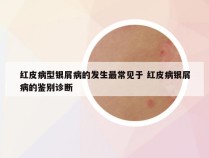 红皮病型银屑病的发生最常见于 红皮病银屑病的鉴别诊断