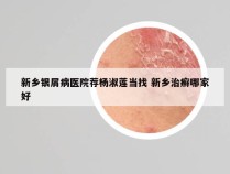 新乡银屑病医院荐杨淑莲当找 新乡治癣哪家好