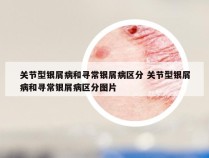 关节型银屑病和寻常银屑病区分 关节型银屑病和寻常银屑病区分图片