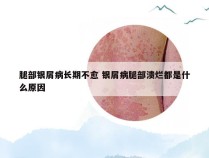 腿部银屑病长期不愈 银屑病腿部溃烂都是什么原因