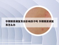 孕期银屑病复发会影响孩子吗 孕期银屑病复发怎么办
