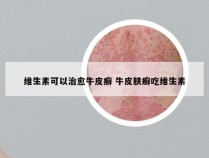 维生素可以治愈牛皮癣 牛皮肤癣吃维生素