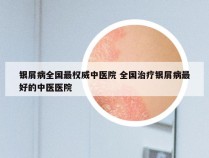 银屑病全国最权威中医院 全国治疗银屑病最好的中医医院
