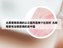 太原看银屑病的公立医院是哪个比较好 太原哪里有治银屑病的老中医
