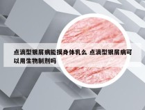 点滴型银屑病能摸身体乳么 点滴型银屑病可以用生物制剂吗