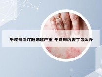 牛皮癣治疗越来越严重 牛皮癣厉害了怎么办