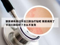 银屑病有用过卡泊三醇治疗贴吧 银屑病用了卡泊三醇后好了怎么不复发
