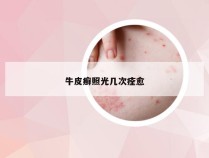牛皮癣照光几次痊愈