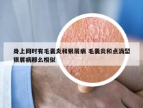 身上同时有毛囊炎和银屑病 毛囊炎和点滴型银屑病那么相似