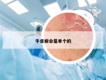 牛皮癣会是单个的