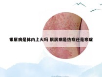 银屑病是体内上火吗 银屑病是热症还是寒症