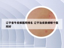 辽宁省牛皮癣医院排名 辽宁治皮肤病哪个医院好
