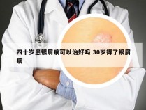 四十岁患银屑病可以治好吗 30岁得了银屑病